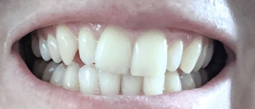 Customer photo review of Refill Kit