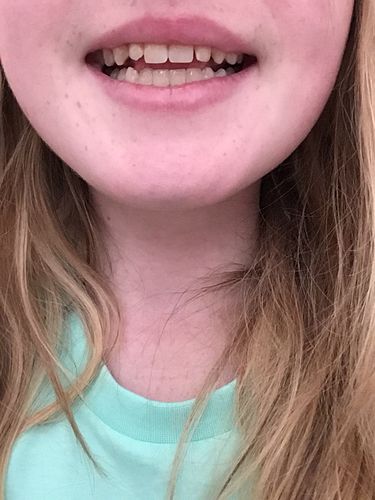 Customer photo review of Teeth Whitening Kit