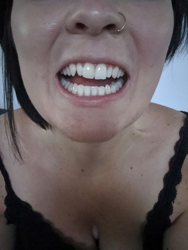 Customer photo review of Charcoal Whitening Pen
