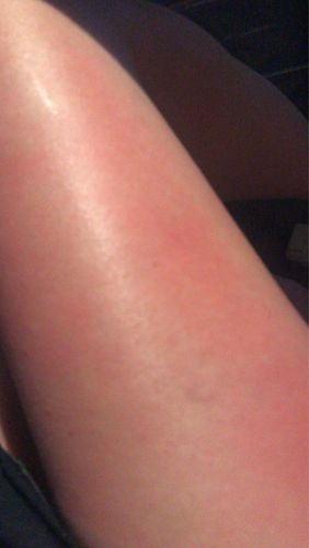 Customer photo review of Electric Cupping Scraping Therapy Massager with Suction Cup - Meridian Dredge Physiotherapy