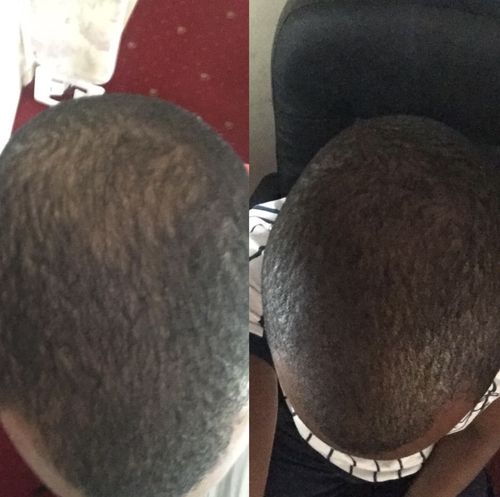 Customer photo review of Inches - Ayurvedic Hair & Beard Growth Oil