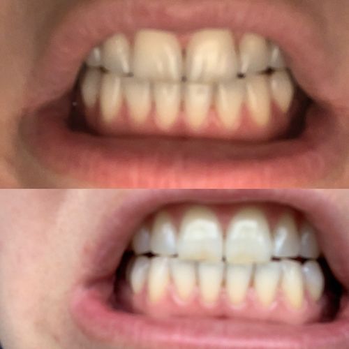 Customer photo review of Teeth Whitening Kit
