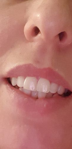 Customer photo review of Refill Kit