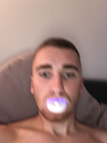 Customer photo review of Teeth Whitening Kit