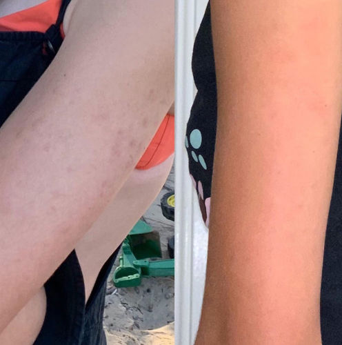 Customer photo review of Salicylsäure BHA 2% 30ml