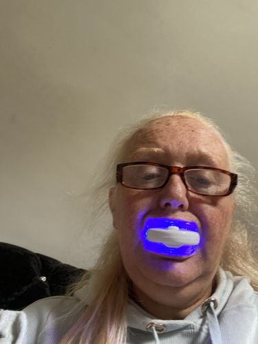 Customer photo review of Teeth Whitening Kit