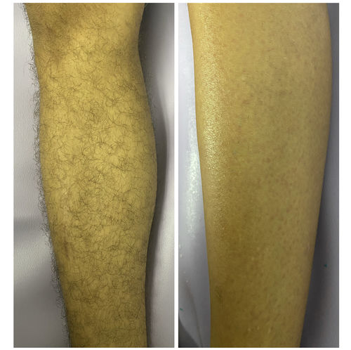 Customer photo review of Signature Series Hair Removal Wax
