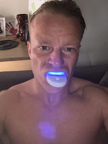 Customer photo review of Teeth Whitening Kit