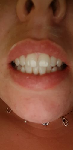 Customer photo review of Teeth Whitening Pen