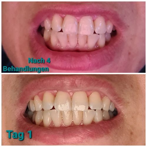 Customer photo review of SmileSecret Phonebleaching®