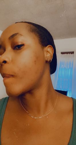 Customer photo review of Fair and White So White Acne Medication Cleanser 250ml / 8.4 fl oz