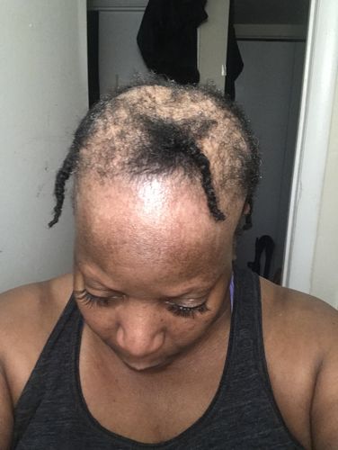 Customer photo review of BEST SELLER (REGROWTH) Hair Serum Extra Strength 1oz