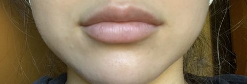 Customer photo review of Lip Fix: Filler
