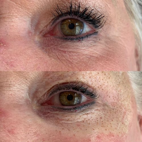 Customer photo review of Plasma Fibroblast Online Training | Limited Discount