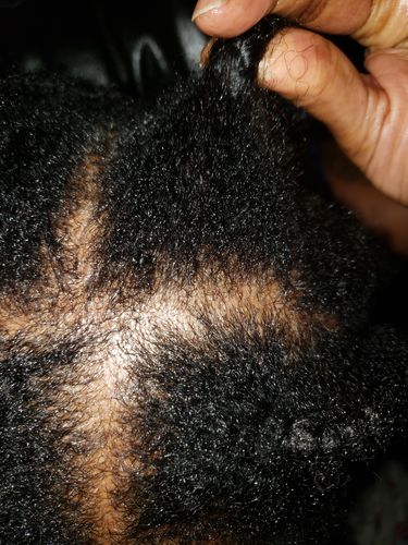 Customer photo review of Hair ReGrowth Serum - Best Friend Kit