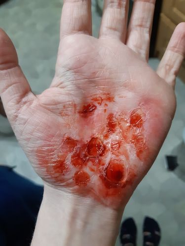 Customer photo review of Ben Nye Clear Latex