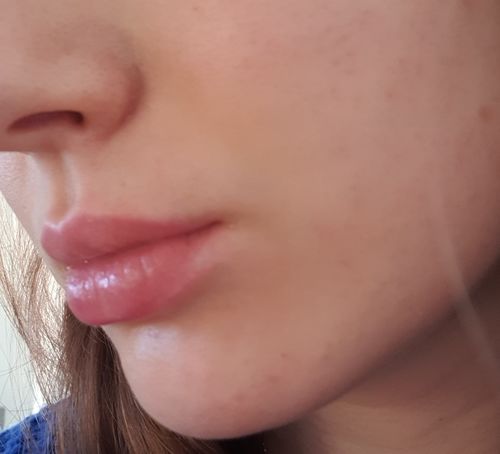 Customer photo review of Salicylsäure BHA 2% 40ml