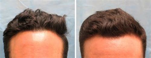 Customer photo review of Anti-Hair Loss with Argan Oil - 10 Minute Miracle - Shampoo 500ml