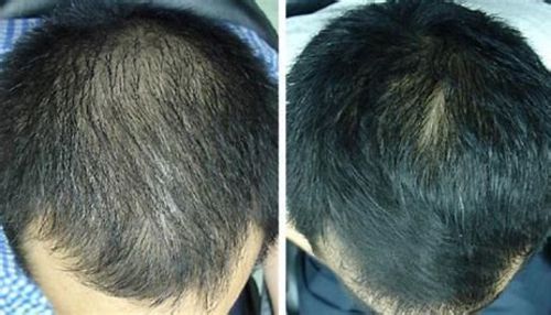 Customer photo review of Anti-Hair Loss With Argan Oil - 10 Minute Miracle - Essential Bundle (Shampoo + Conditioner)