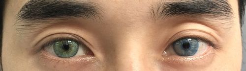 Customer photo review of Aurora Blue Contact Lenses(12 months wear)