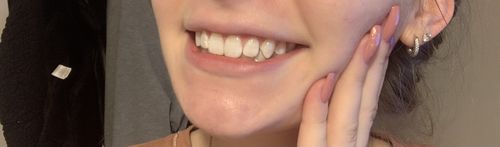 Customer photo review of Teeth Whitening Strips