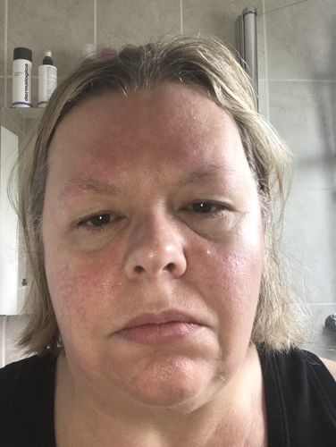 Customer photo review of Rosalique 3 in 1 Anti-Redness Miracle Formula SPF50