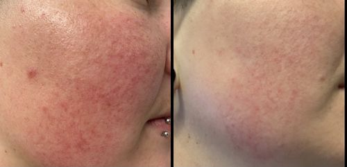 Customer photo review of Cleoglam Hyper Sensitive Gel "The Magical One" 30ml