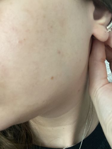 Customer photo review of ערכה טיפולית לעור שמן ופצעונים | AC - CLEAR CONTROL KIT