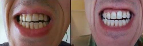 Customer photo review of Clareador Intensive Stain Removal