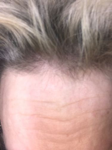 Customer photo review of Hair Regrowth Serum - Extra Strength (Large Bottle)