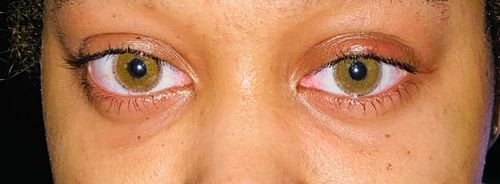 Customer photo review of Icoloured® Aurora Blue Colored Contact Lenses
