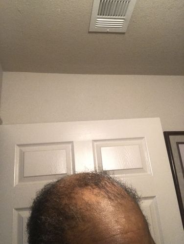 Customer photo review of Scalp Soothing Mist (8oz)