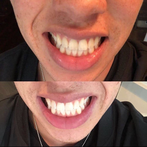 Customer photo review of Teeth Whitening Kit