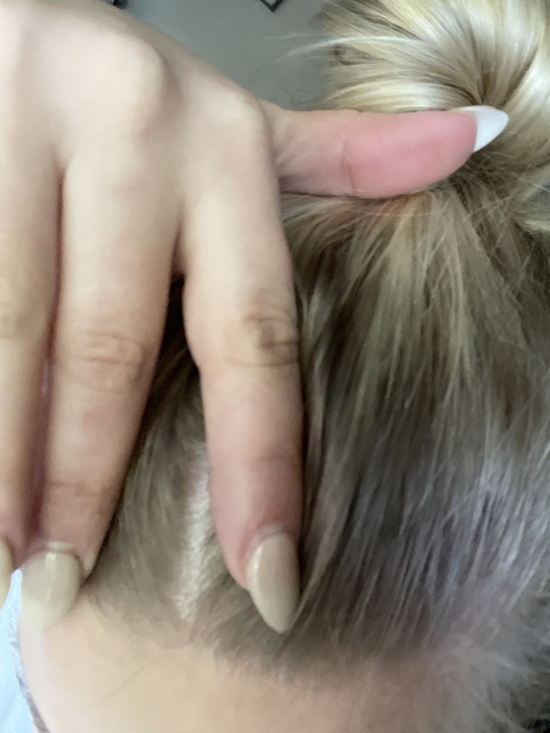 Customer photo review of Psoriasis Honey Scalp Nourishing Kit