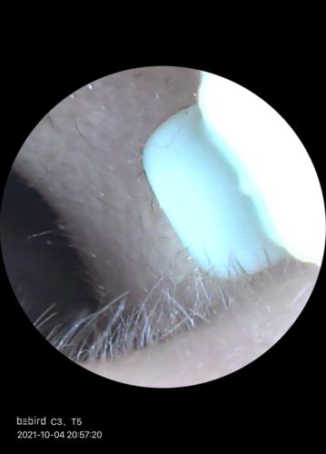 Customer photo review of Bee Gone Wax - Ear Wax Removal Tool