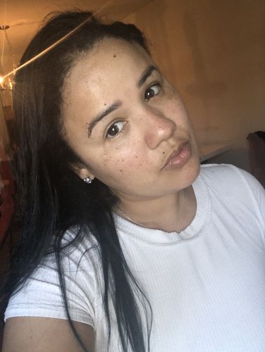 Customer photo review of SkinFix: Chemical Peel