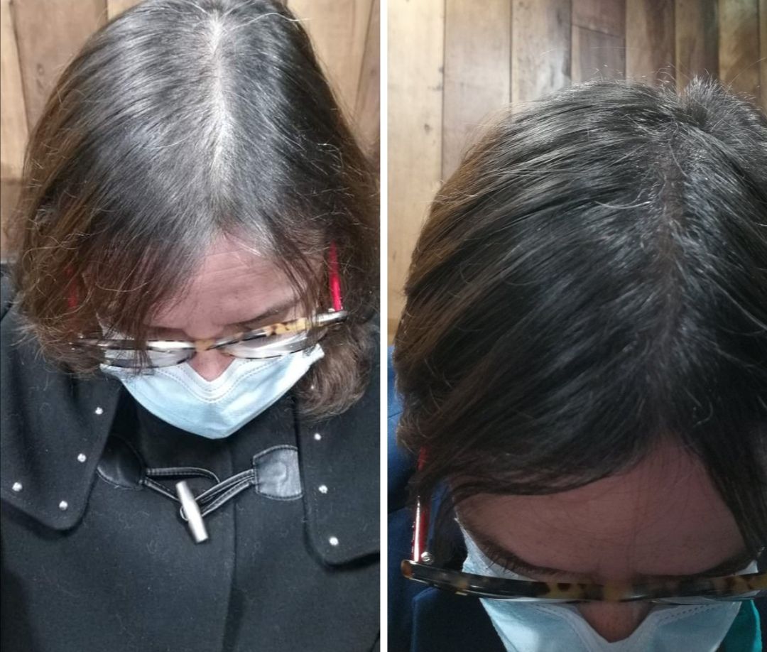 Customer photo review of Anticaída para 3 meses