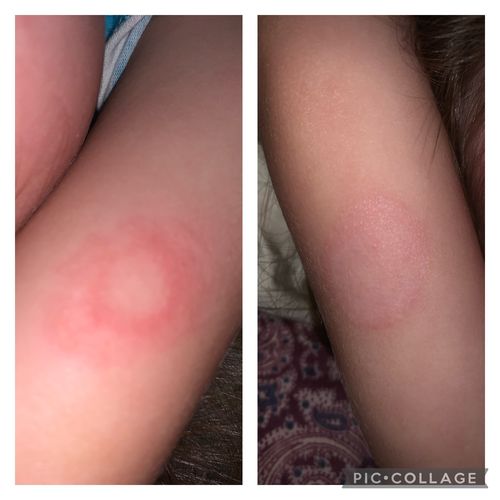 Customer photo review of Ringworm Treatment