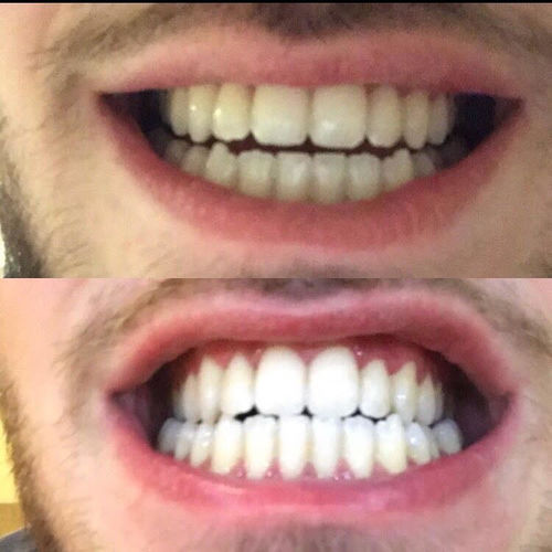 Gleam™ Teeth Whitening Kit