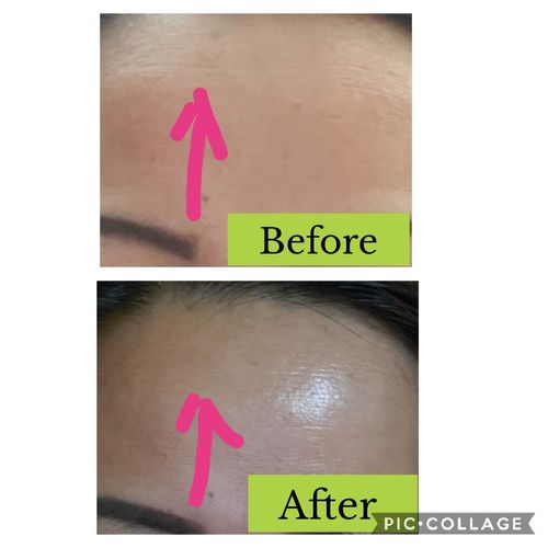 Customer photo review of Dermavel - Solo Kit