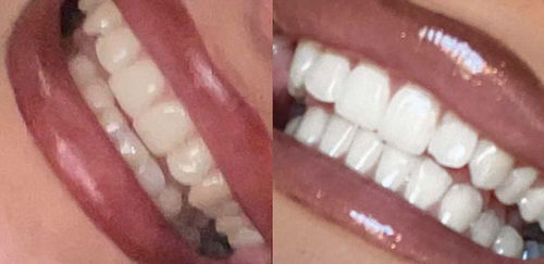 Customer photo review of Teeth Whitening Kit