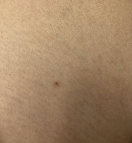 Customer photo review of Dermavel - Solo Kit