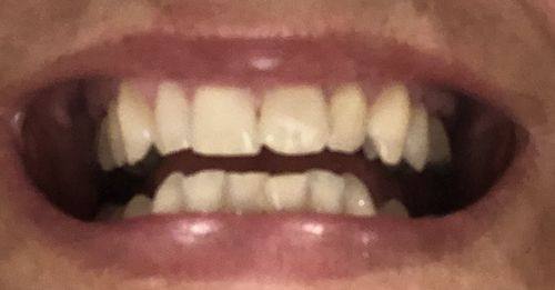 Customer photo review of Refill Kit