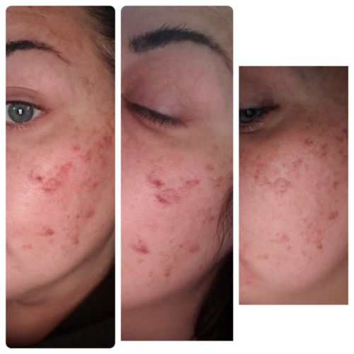 Customer photo review of Dermavel - Solo Kit