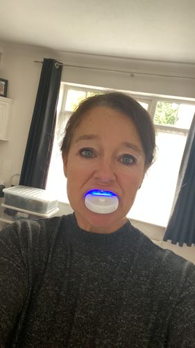 Customer photo review of Teeth Whitening Kit