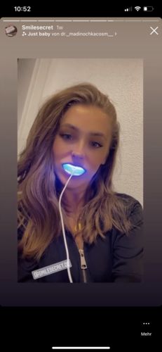 Customer photo review of PAP+ LED Teeth Whitening Kit