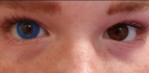 Customer photo review of MOJOSEE Pure Blue Ring Colored Contact Lenses