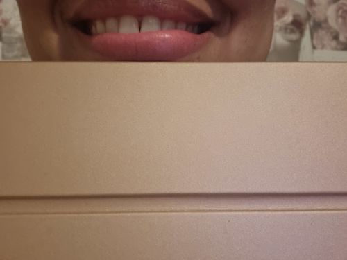 Customer photo review of Teeth Whitening Kit