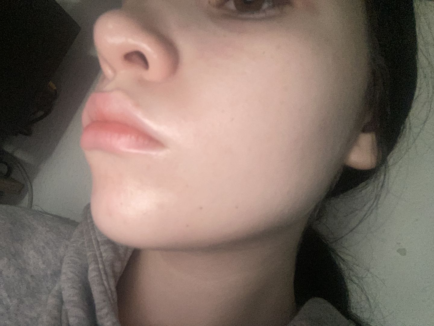 Customer photo review of PRE ORDER: Salicylsäure BHA 2% 50 ml