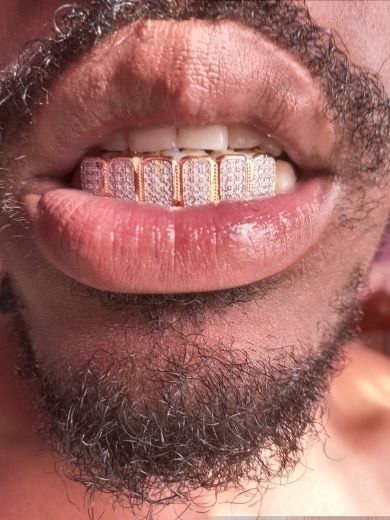 Customer photo review of Two-Tone Iced Grillz